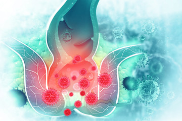 Acute Anal Fissure